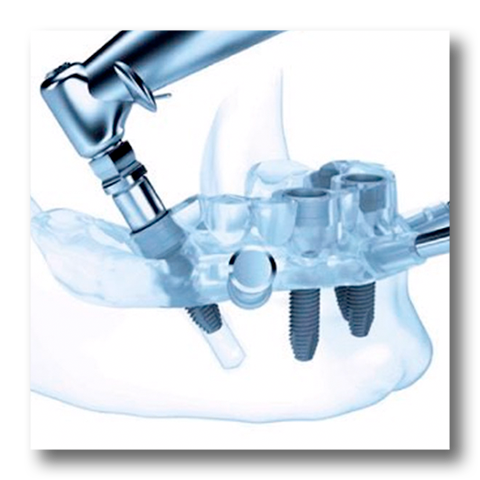 Implantes guiados
