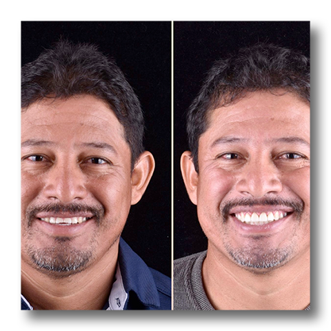 Metas dentales